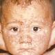 Smallpox pic