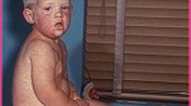 Timeline: German Measles