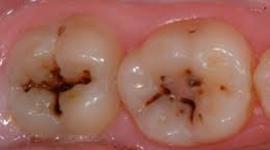 Timeline: CARIES DENTAL