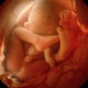 Nilsson rm photo 36 week fetus