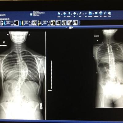 Timeline: My Back Surgery 2012 - Present Day