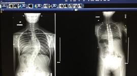 Timeline: My Back Surgery 2012 - Present Day