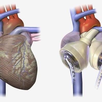 Timeline: The Artificial Heart