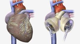 Timeline: The Artificial Heart