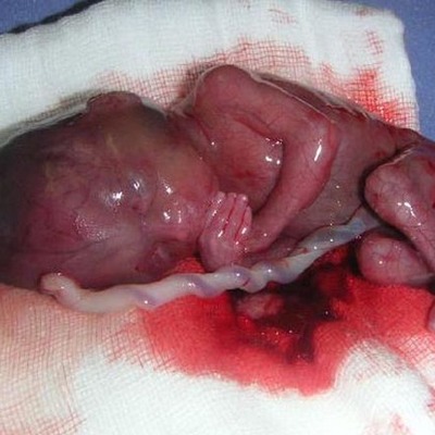 Timeline: PROCESO DEL ABORTO