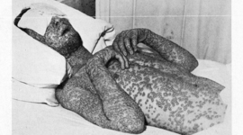 Timeline: Smallpox