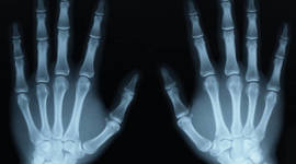 Timeline: History and the evolution of X-rays