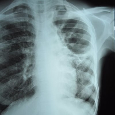 Timeline: Tuberculosis