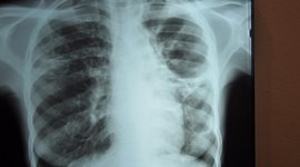 Timeline: Tuberculosis