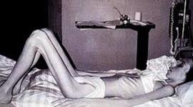 Timeline: Trastornos alimenticios a través del tiempo