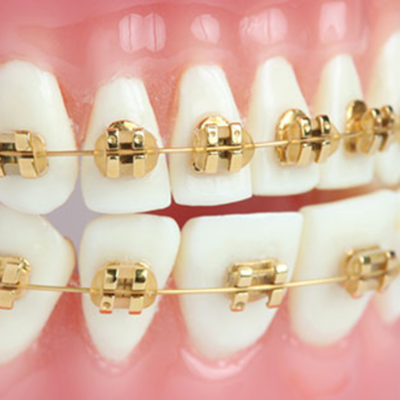 Timeline: History of Braces