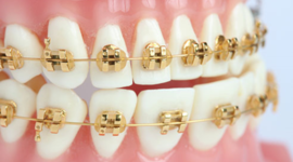Timeline: History of Braces