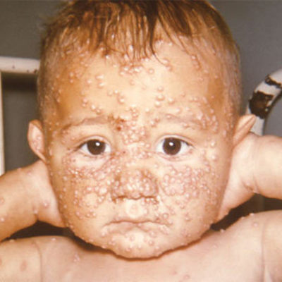 Timeline: Smallpox