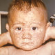 Smallpox baby