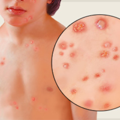 Timeline: typhoid fever- Sam