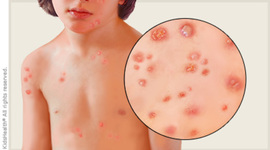 Timeline: typhoid fever- Sam