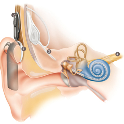 Timeline: History of the Cochlear Implant