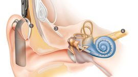 Timeline: History of the Cochlear Implant