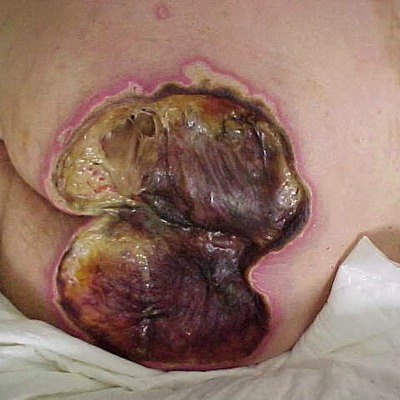 Timeline: ULCERAS POR PRESION