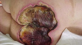 Timeline: ULCERAS POR PRESION