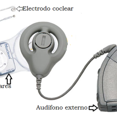 Timeline: EVOLUCIÓN HISTORICA DEL IMPLANTE COCLEAR