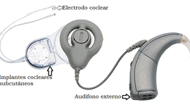 Timeline: EVOLUCIÓN HISTORICA DEL IMPLANTE COCLEAR