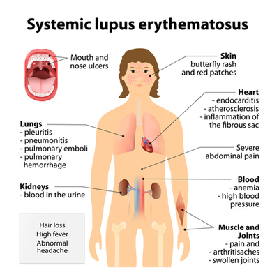 Timeline: Systemic Lupus Erthematous