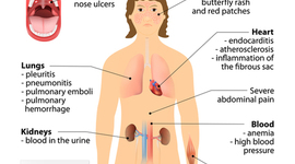 Timeline: Systemic Lupus Erthematous