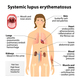 Signs and symptoms of systemic lupus erythematosus