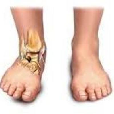 Timeline: Tiempos de reparación de los diversos tejidos: óseo, muscular, tendinoso y ligamentoso.