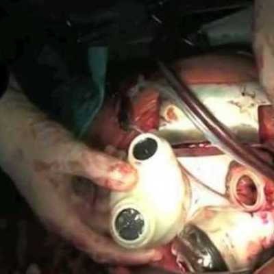Timeline: artificial heart