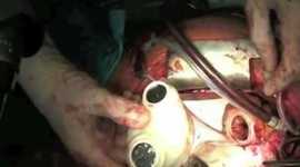 Timeline: artificial heart