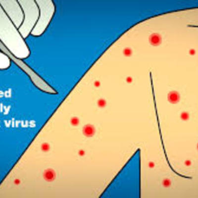 Timeline: Evolution of Small Pox