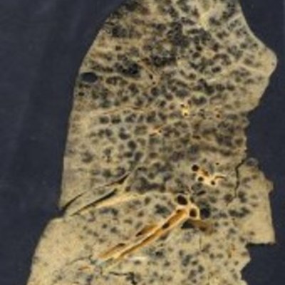 Timeline: Black Lung