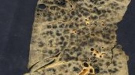 Timeline: Black Lung