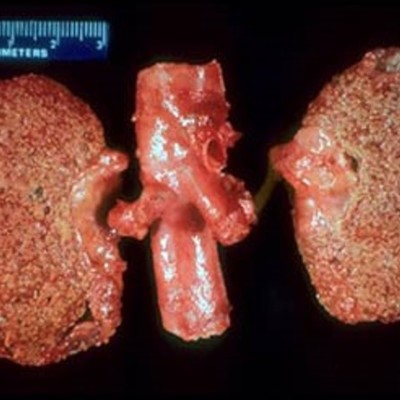 Timeline: Caso clínico Sistema Renal - Mary Maloof