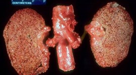 Timeline: Caso clínico Sistema Renal - Mary Maloof