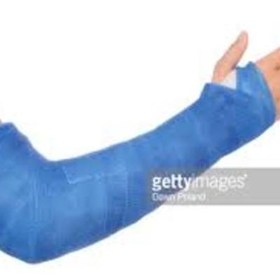 Timeline: breaking my arm