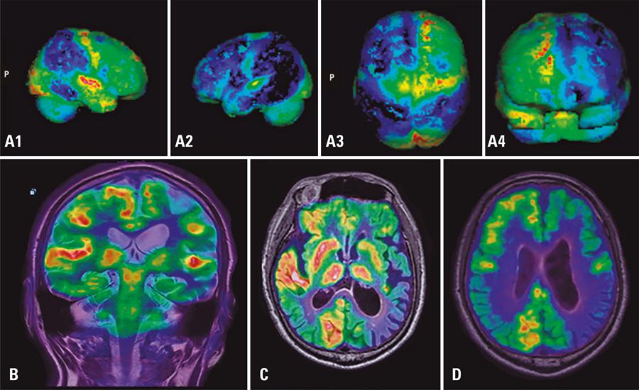 Пэт-кт головного мозга с 18 фдг. Фдг в головном мозге что это. Positron emission tomography. Фдг в головном мозге что это. Очаг гиперфиксации рфп что это.