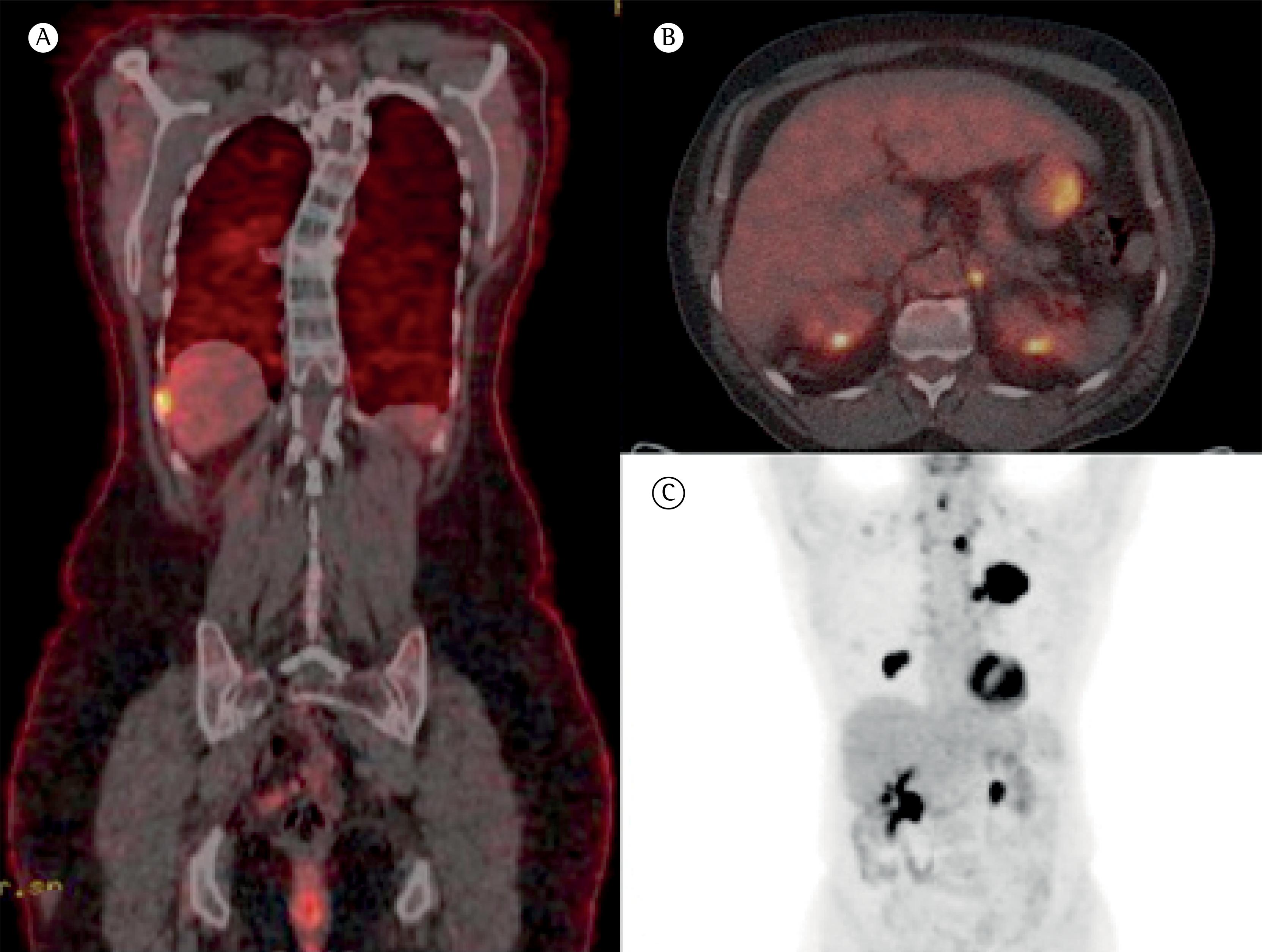 PET/TC em câncer de pulmão indicações