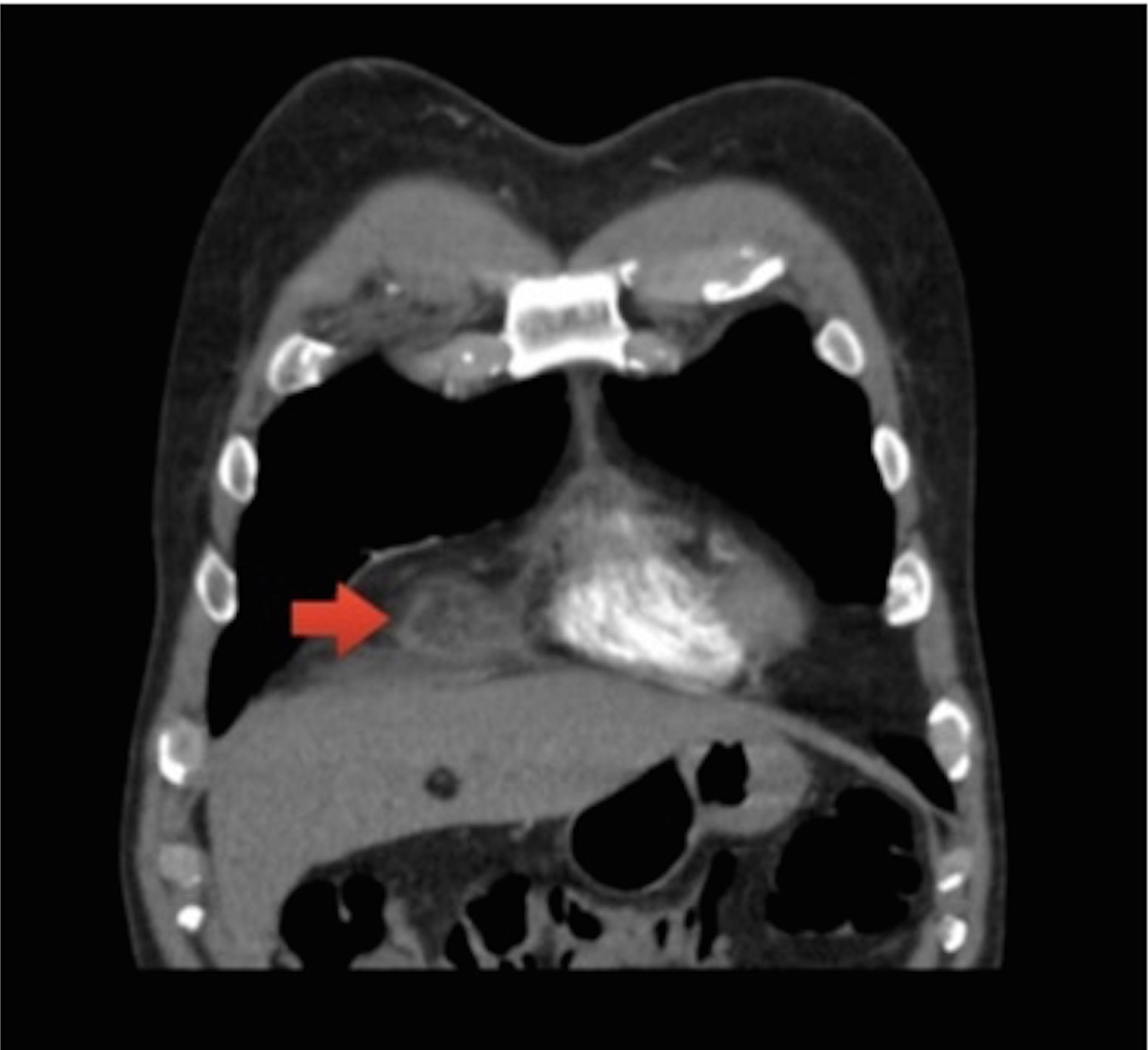 Necrose da Gordura Epipericárdica. Um Importante