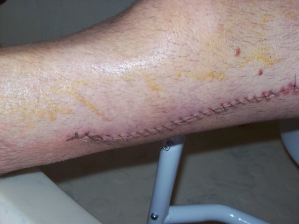 Thomas (Todd) Lenzini's album, Broken Bike and Body