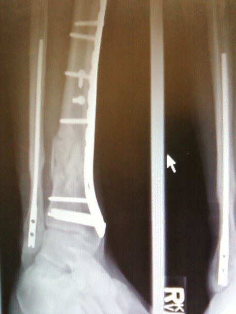 Thomas (Todd) Lenzini's album, Broken Bike and Body