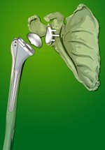 Frederick Chubner's album, TOTAL SHOULDER REPLACEMENT