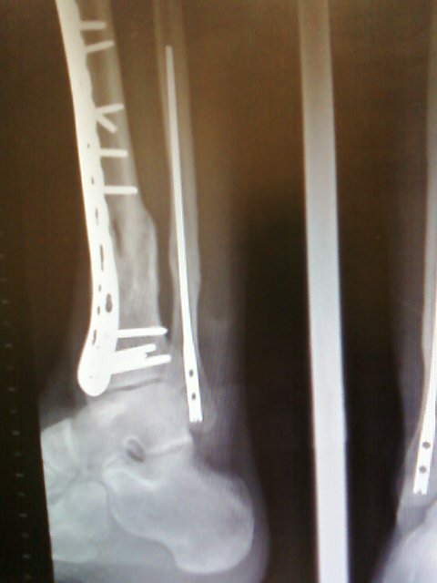 Thomas (Todd) Lenzini's album, Broken Bike and Body