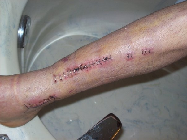 Thomas (Todd) Lenzini's album, Broken Bike and Body