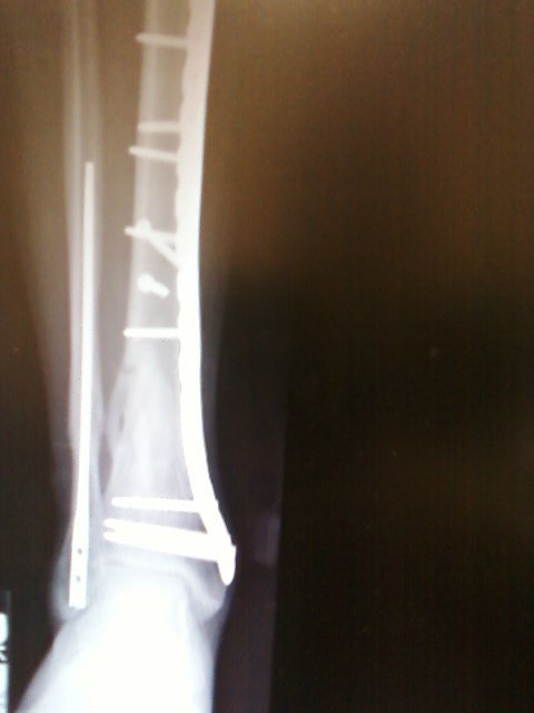 Thomas (Todd) Lenzini's album, Broken Bike and Body