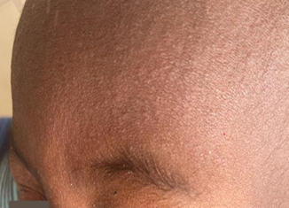 Close-up of a person's forehead and eyebrow.