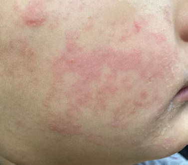 Close-up of a person's cheek with areas of redness.