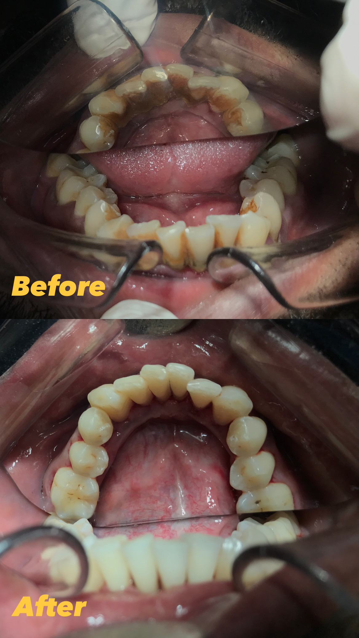 Dental Scaling
